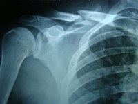 Fast Eddie breaks collarbone